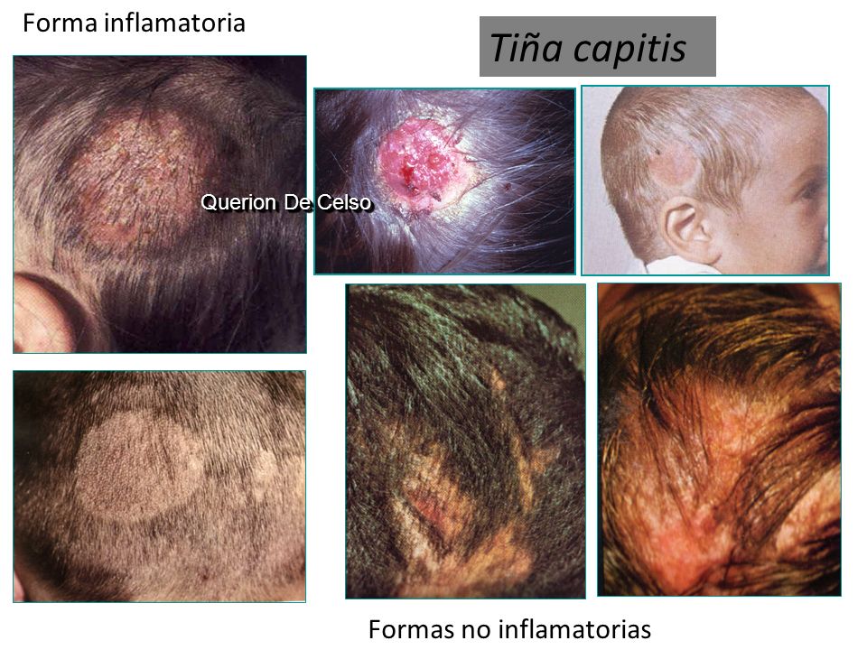 Tina inflamatoria del cuero cabelludo